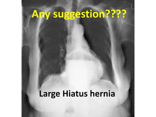 Any suggestion????
Large Hiatus hernia
 