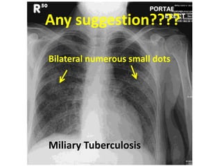 Any suggestion????
Bilateral numerous small dots
Miliary Tuberculosis
 