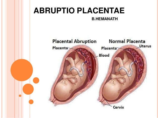 abruptio placentae betekenis