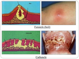 Furuncle (boil)
Carbuncle
 