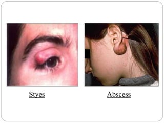 Styes Abscess
 