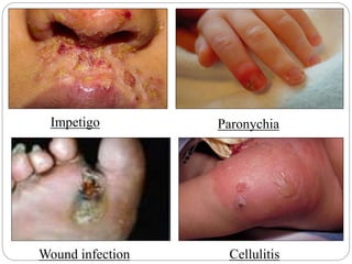 Impetigo Paronychia
Cellulitis
Wound infection
 