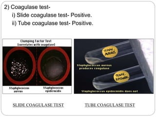 2) Coagulase test-
i) Slide coagulase test- Positive.
ii) Tube coagulase test- Positive.
SLIDE COAGULASE TEST TUBE COAGULASE TEST
 