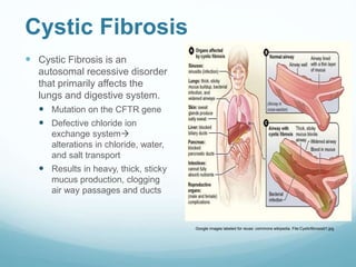 Cystic Fibrosis
 Cystic Fibrosis is an
autosomal recessive disorder
that primarily affects the
lungs and digestive system.
 Mutation on the CFTR gene
 Defective chloride ion
exchange system
alterations in chloride, water,
and salt transport
 Results in heavy, thick, sticky
mucus production, clogging
air way passages and ducts
Google images labeled for reuse: commons wikipedia. File:Cysticfibrosis01.jpg
 