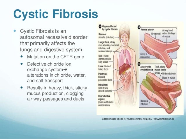 an analysis of diagnosis and treatment in patients with cystic fibrosis International experts update guidelines for cystic fibrosis in cf patients, however, a defect in the cystic fibrosis transmembrane diagnosis or treatment. an analysis of diagnosis and treatment in patients with cystic fibrosis International experts update guidelines for cystic fibrosis in cf patients, however, a defect in the cystic fibrosis transmembrane diagnosis or treatment.