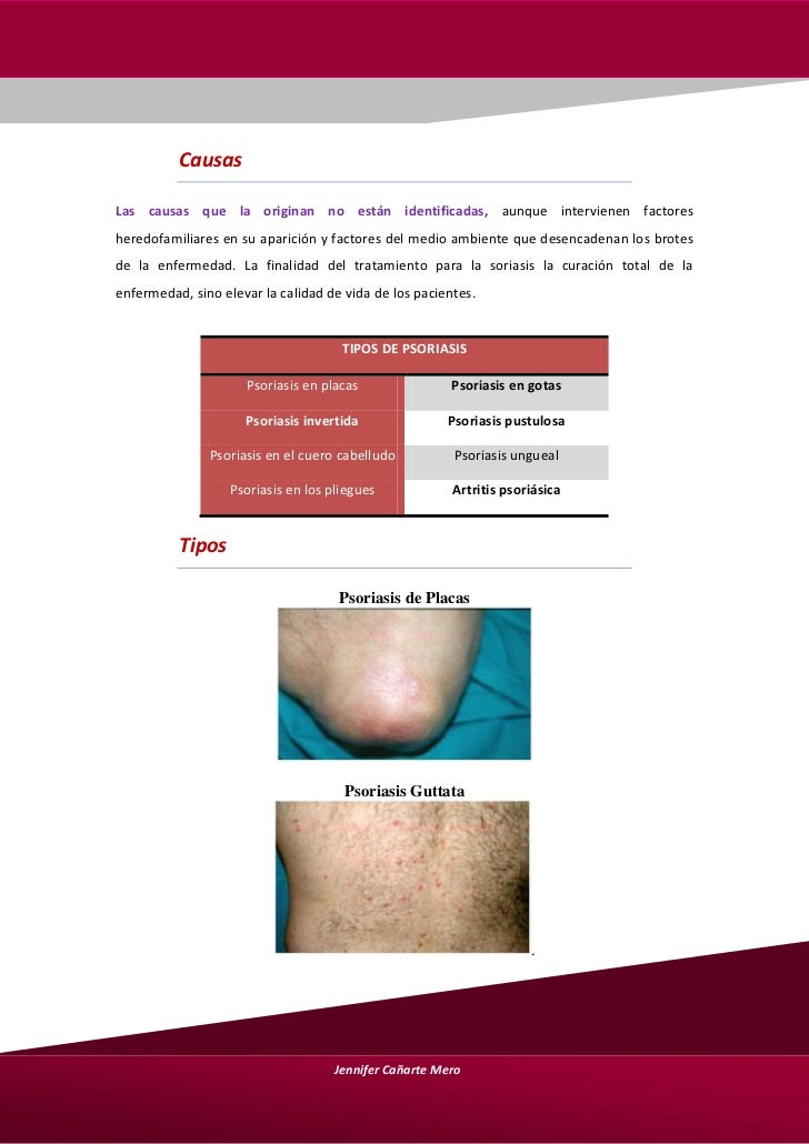 El impacto de la psoriasis a la esterilidad