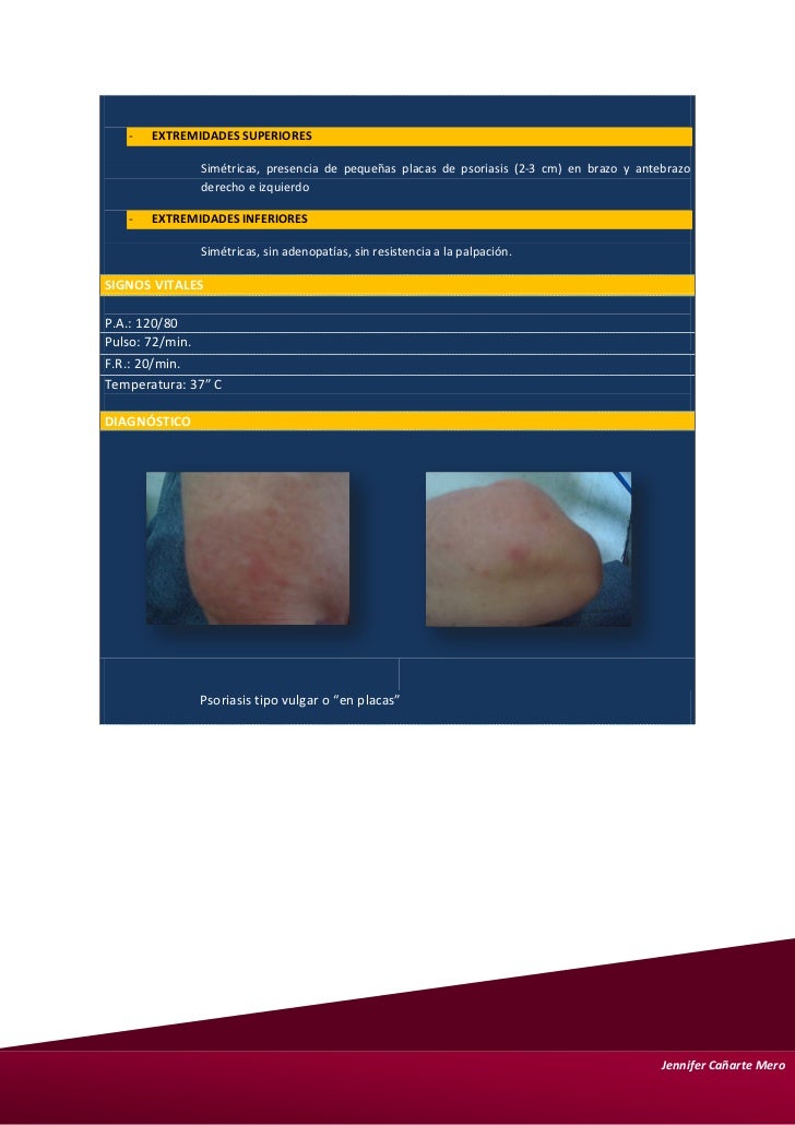 El enlace de la psoriasis con la artritis