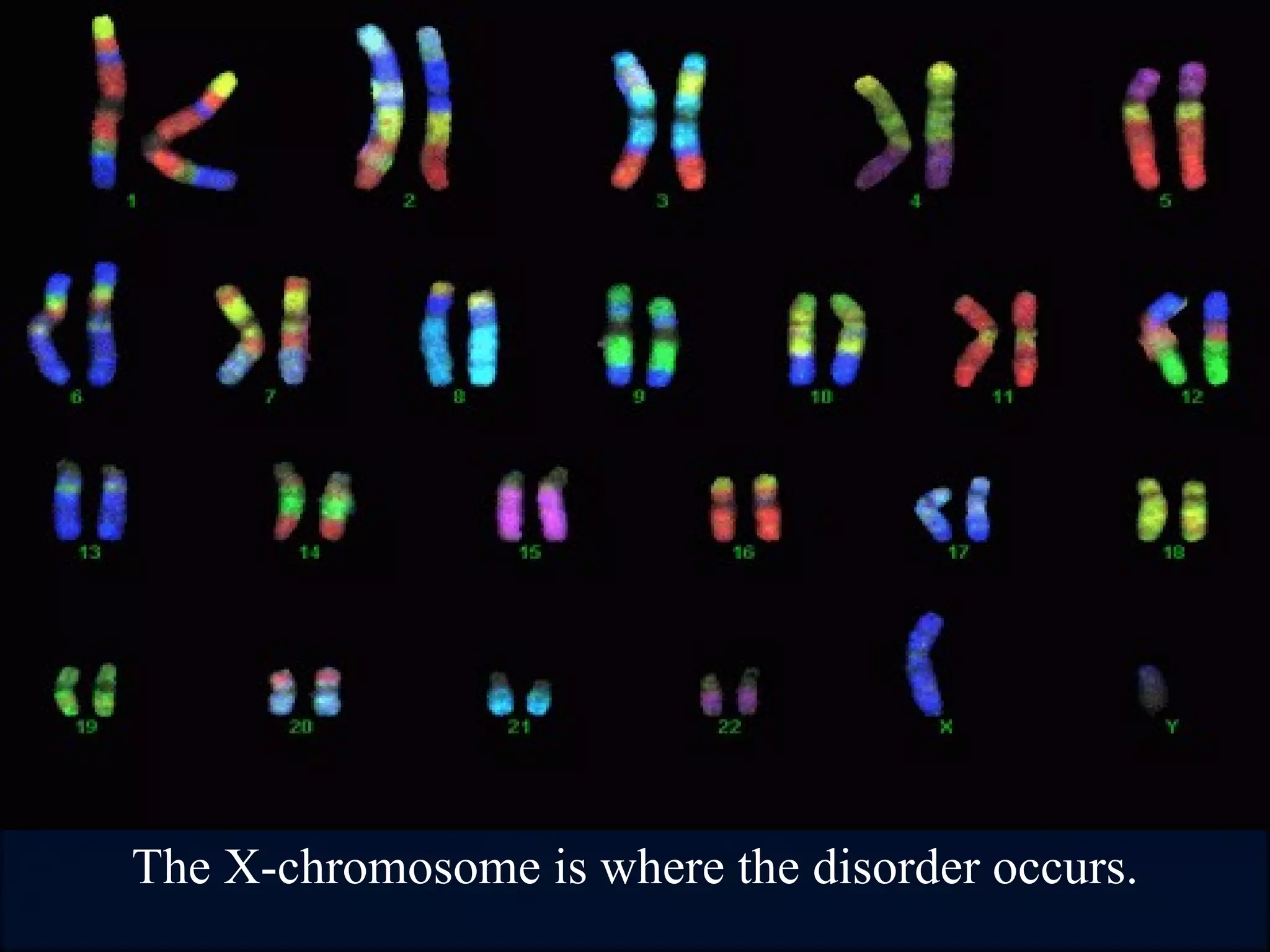 Duchenne Muscular Dystrophy (DMD) PPT