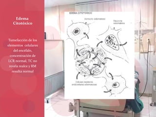 Tumefacción de los
elementos celulares
del encéfalo,
concentración de
LCR normal, TC no
revela realce y RM
resulta normal
Edema
Citotóxico
 