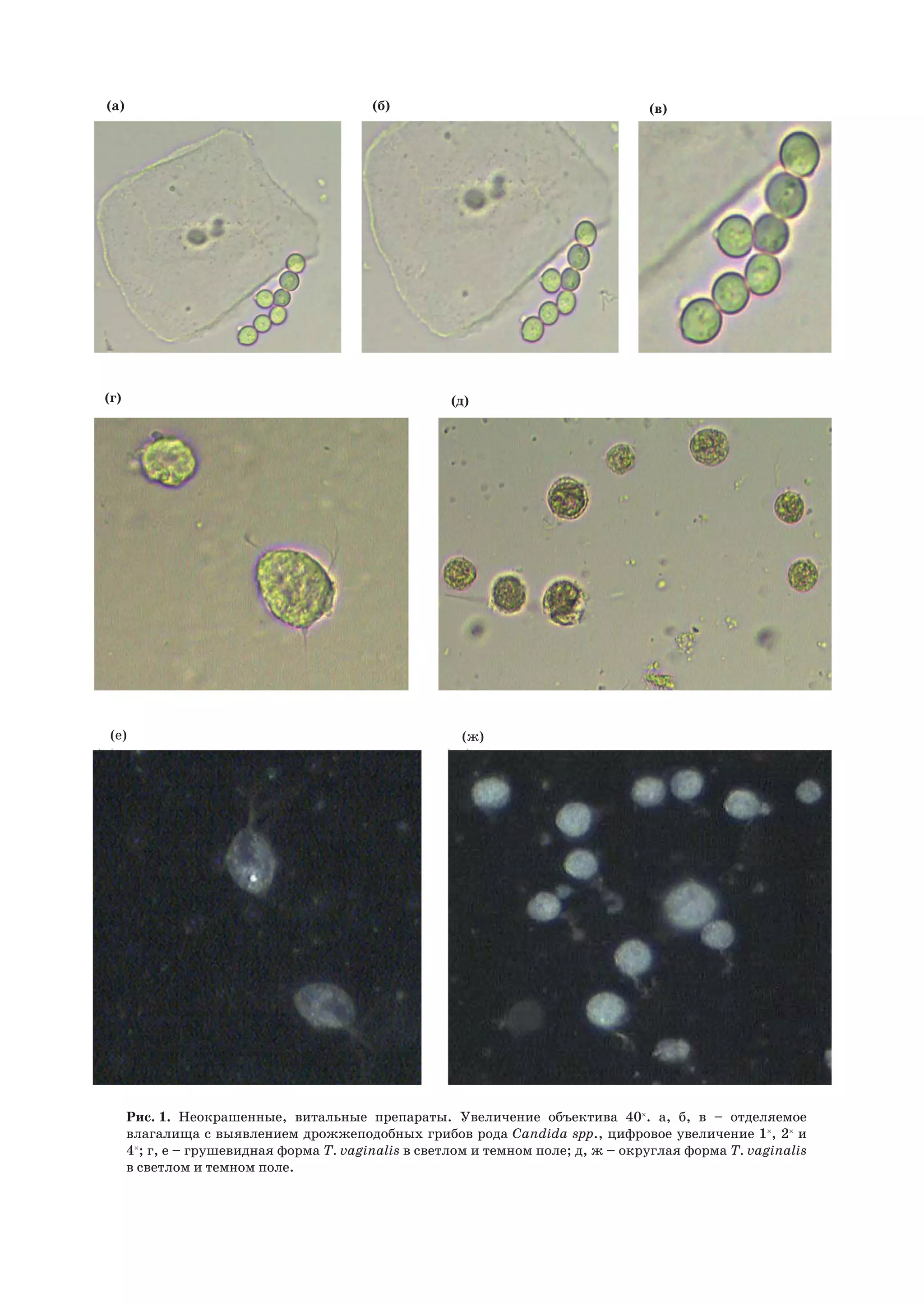 (д)
(а)
(е)
(б)
(ж)
(в)
(г)
Рис.  1. Неокрашенные, витальные препараты. Увеличение объектива 40×
. а, б, в – отделяемое
влагалища с выявлением дрожжеподобных грибов рода Candida spр., цифровое увеличение 1×
, 2×
и
4×
; г, е – грушевидная форма T. vaginalis в светлом и темном поле; д, ж – округлая форма T. vaginalis
в светлом и темном поле.
 