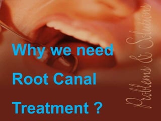 Why we need
Root Canal
Treatment ?
 