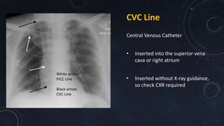 Chest Interpretation Year 3 REVISED | PPTX