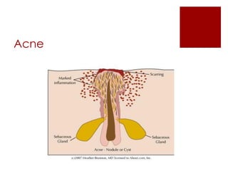 Acne Nódulo-Cística  
