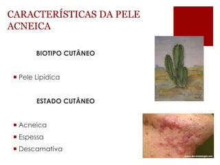 CARACTERÍSTICAS DA PELE ACNEICA 
BIOTIPO CUTÂNEO 
Pele Lipídica 
ESTADO CUTÂNEO 
Acneica 
Espessa 
Descamativa  