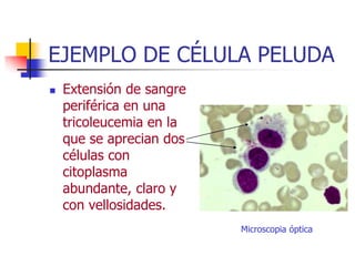 EJEMPLO DE CÉLULA PELUDA
   Extensión de sangre
    periférica en una
    tricoleucemia en la
    que se aprecian dos
    células con
    citoplasma
    abundante, claro y
    con vellosidades.
                          Microscopia óptica
 