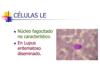 CÉLULAS LE

   Núcleo fagocitado
    no característico.
   En Lupus
    eritematoso
    diseminado.
 
