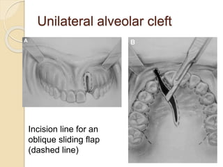 Unilateral alveolar cleft
Incision line for an
oblique sliding flap
(dashed line)
 