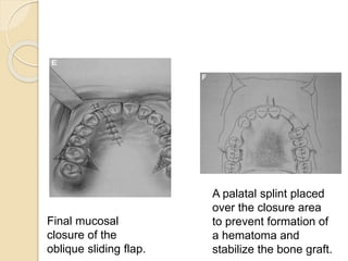 Final mucosal
closure of the
oblique sliding flap.
A palatal splint placed
over the closure area
to prevent formation of
a hematoma and
stabilize the bone graft.
 
