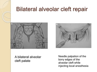 Bilateral alveolar cleft repair
A bilateral alveolar
cleft palate
Needle palpation of the
bony edges of the
alveolar cleft while
injecting local anesthesia
 