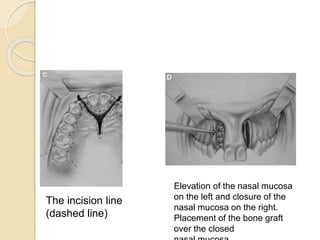 The incision line
(dashed line)
Elevation of the nasal mucosa
on the left and closure of the
nasal mucosa on the right.
Placement of the bone graft
over the closed
 