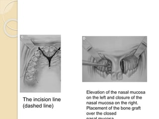  alveolar bone grafting Slide 56