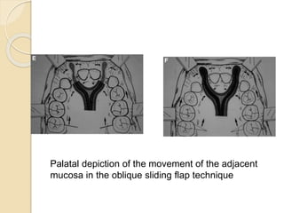 Palatal depiction of the movement of the adjacent
mucosa in the oblique sliding flap technique
 