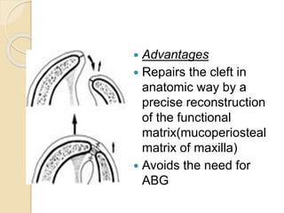  Advantages
 Repairs the cleft in
anatomic way by a
precise reconstruction
of the functional
matrix(mucoperiosteal
matrix of maxilla)
 Avoids the need for
ABG
 
