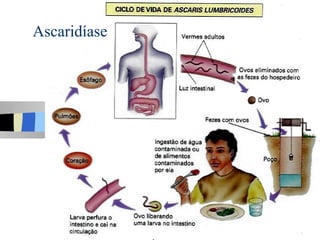 Ascaridíase
 