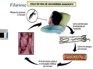 Filariose
 