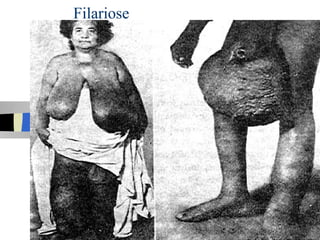 Filariose
 