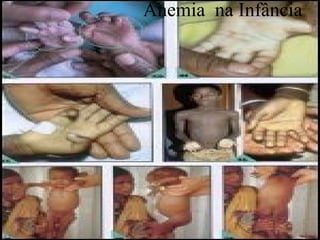 Anemia na Infância
 