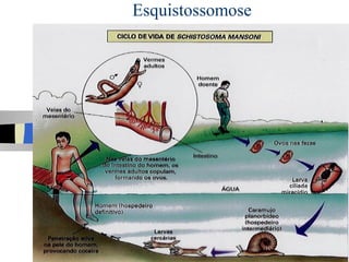 Esquistossomose
 