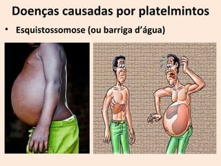 Doenças causadas por platelmintos
• Esquistossomose (ou barriga d’água)
 