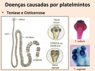 Doenças causadas por platelmintos
• Teníase e Cisticercose
T. sollium
T. saginata
 