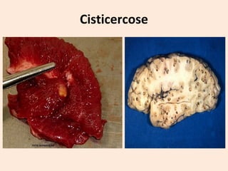 Cisticercose
 