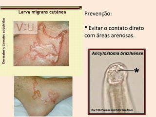 Prevenção:
 Evitar o contato direto
com áreas arenosas.
 