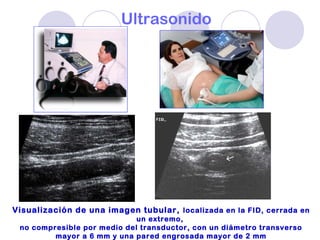 Ultrasonido
Visualización de una imagen tubular, localizada en la FID, cerrada en
un extremo,
no compresible por medio del transductor, con un diámetro transverso
mayor a 6 mm y una pared engrosada mayor de 2 mm
 