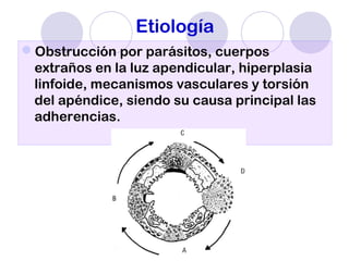 Etiología
Obstrucción por parásitos, cuerpos
extraños en la luz apendicular, hiperplasia
linfoide, mecanismos vasculares y torsión
del apéndice, siendo su causa principal las
adherencias.
 