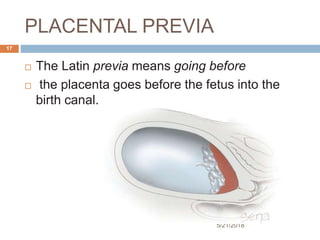 PLACENTAL PREVIA
5/21/2018
17
 The Latin previa means going before
 the placenta goes before the fetus into the
birth ca...