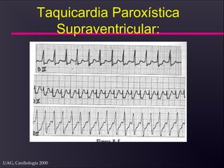 UAG, Cardiología 2000
Taquicardia Paroxística
Supraventricular:
 
