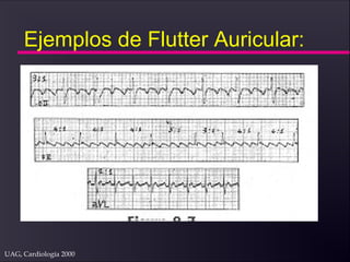 UAG, Cardiología 2000
Ejemplos de Flutter Auricular:
 