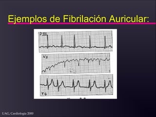 UAG, Cardiología 2000
Ejemplos de Fibrilación Auricular:
 