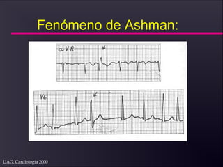 UAG, Cardiología 2000
Fenómeno de Ashman:
 