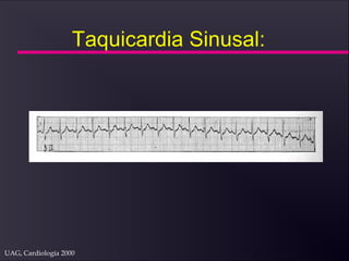 UAG, Cardiología 2000
Taquicardia Sinusal:
 