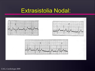 UAG, Cardiología 2000
Extrasistolia Nodal:
 
