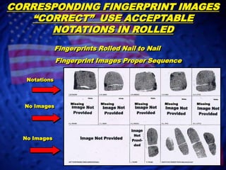 ACCEPTABLE NOTATIONS IN FINGERPRINT BLOCKS: Electronic Codes – XX (Amputated) or UP                (Unable to Print).	 Paper Fingerprint Notations – AMP   Amputated, XX, Tip-AMP, 	  Missing at Birth (MAB), Cut-Off, Shot-Off,            Deformed, Bandaged, Cast, Missing  Unable to Print or UP	