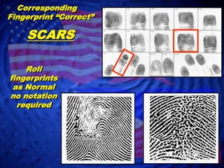  “CORRECT” NOTATION IN FINGERPRINT BLOCK OR CORRESPONDING IMAGE  Tip Amputation(s)   Less than half of   first joint is     missing Ensure the   finger(s) is in the   rolled and plain     impressions AFIS will read this    as minutia