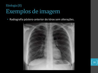 Etiologia (II)

Exemplos de imagem
 • Radiografia póstero-anterior do tórax sem alterações.




                                                           16
 