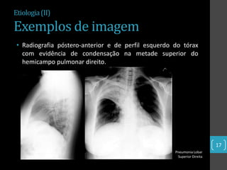 Etiologia (II)

Exemplos de imagem
 • Radiografia póstero-anterior e de perfil esquerdo do tórax
   com evidência de condensação na metade superior do
   hemicampo pulmonar direito.




                                                                         17
                                                     Pneumonia Lobar
                                                      Superior Direita
 