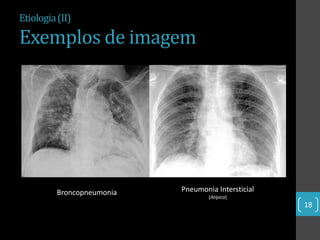 Etiologia (II)

Exemplos de imagem




          Broncopneumonia   Pneumonia Intersticial
                                    (Atípica)
                                                     18
 